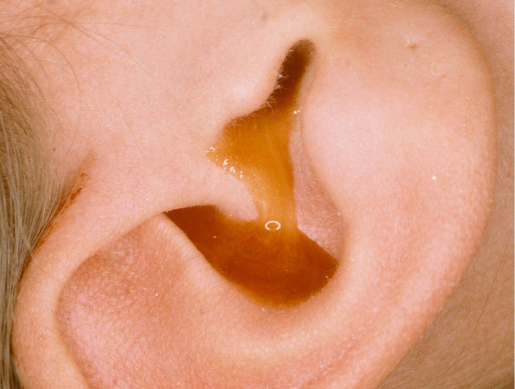 Bài thuốc chữa viêm tai giữa bằng thuốc đông y nào hiệu quả nhất? 2